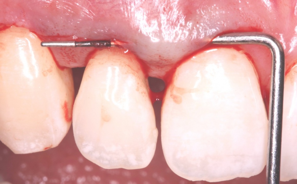 Submucosal tunneling preparation lifting papillae on both sides of the defect