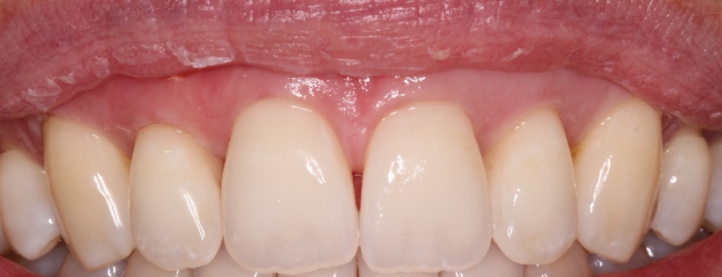 Harmonization of the gingiva line obvious after 6 months